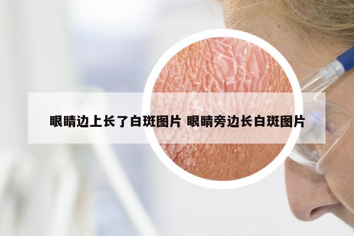 眼睛边上长了白斑图片 眼睛旁边长白斑图片