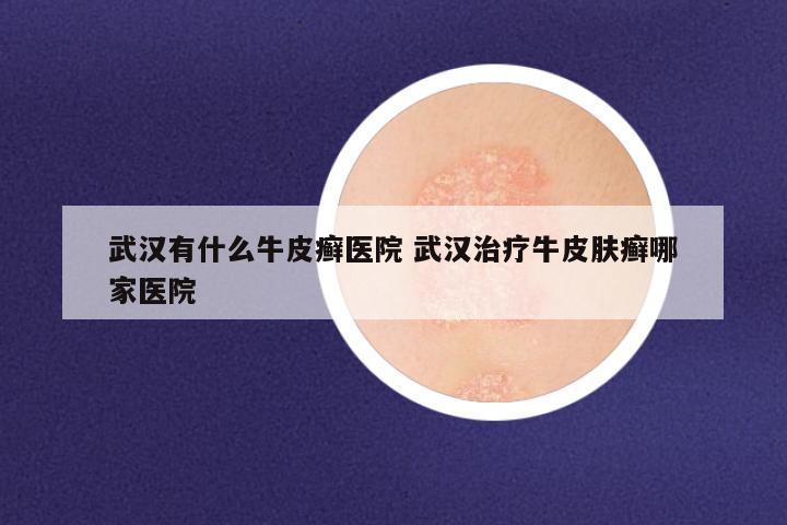武汉有什么牛皮癣医院 武汉治疗牛皮肤癣哪家医院