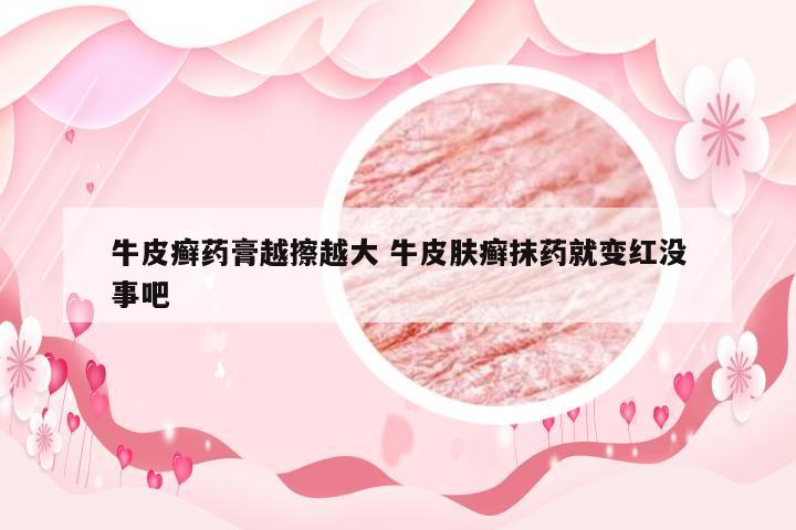 牛皮癣药膏越擦越大 牛皮肤癣抹药就变红没事吧