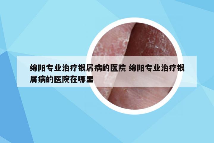 绵阳专业治疗银屑病的医院 绵阳专业治疗银屑病的医院在哪里