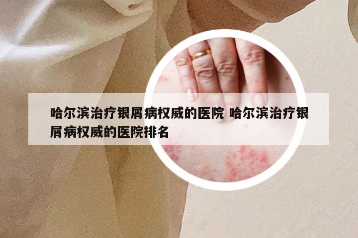 哈尔滨治疗银屑病权威的医院 哈尔滨治疗银屑病权威的医院排名