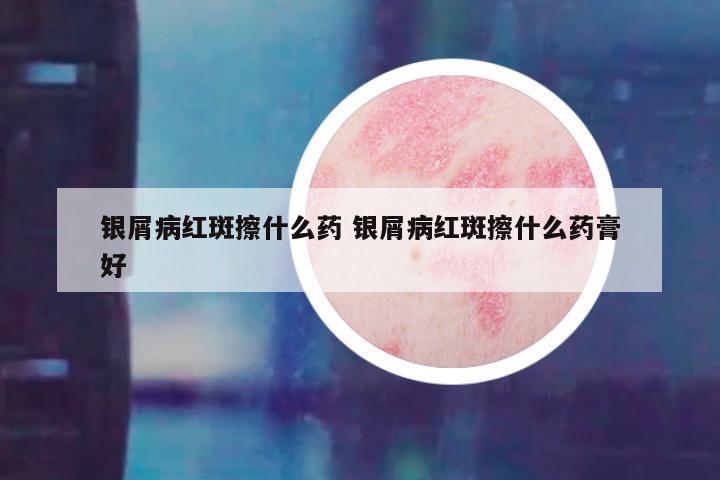银屑病红斑擦什么药 银屑病红斑擦什么药膏好