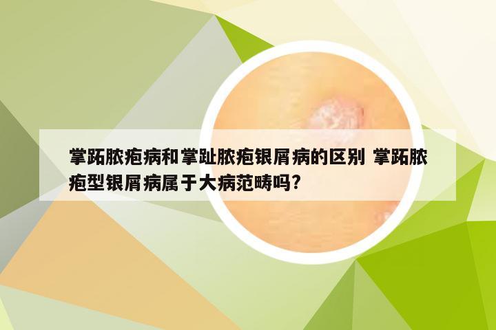 掌跖脓疱病和掌趾脓疱银屑病的区别 掌跖脓疱型银屑病属于大病范畴吗?