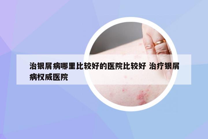 治银屑病哪里比较好的医院比较好 治疗银屑病权威医院