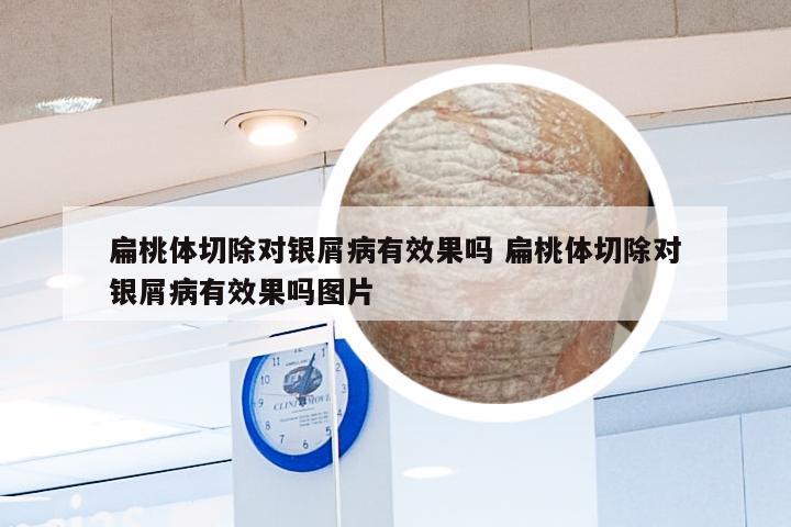 扁桃体切除对银屑病有效果吗 扁桃体切除对银屑病有效果吗图片