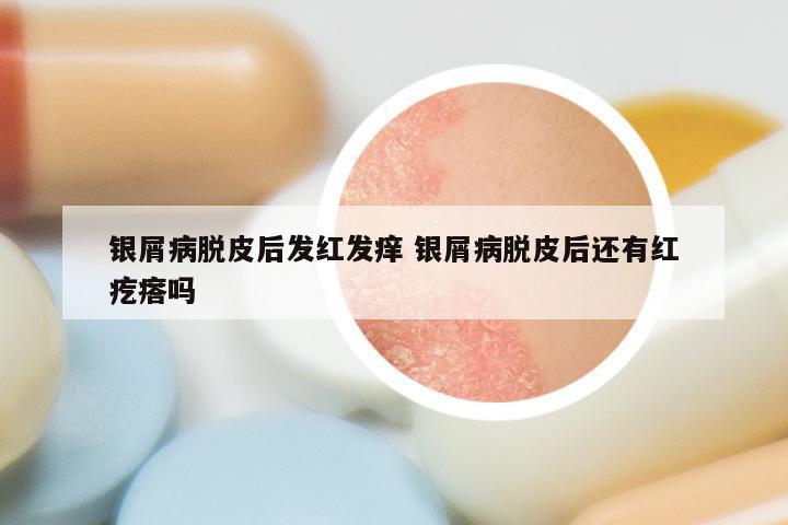 银屑病脱皮后发红发痒 银屑病脱皮后还有红疙瘩吗