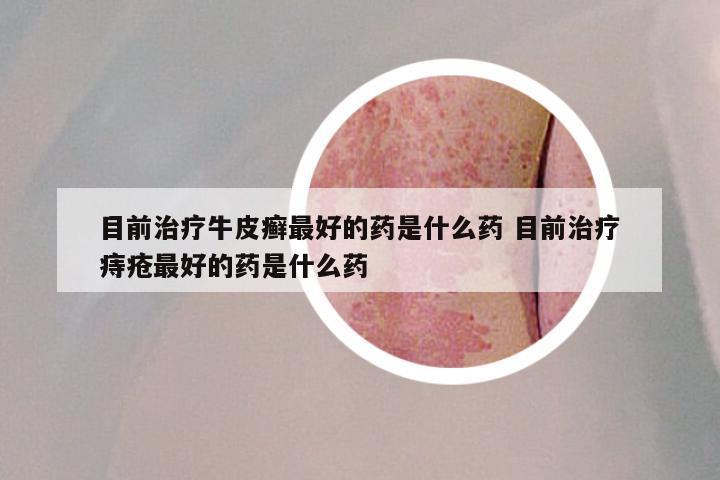 目前治疗牛皮癣最好的药是什么药 目前治疗痔疮最好的药是什么药