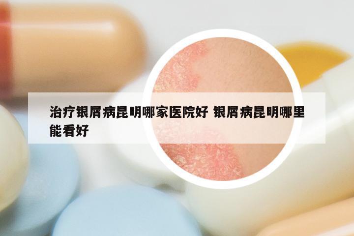治疗银屑病昆明哪家医院好 银屑病昆明哪里能看好