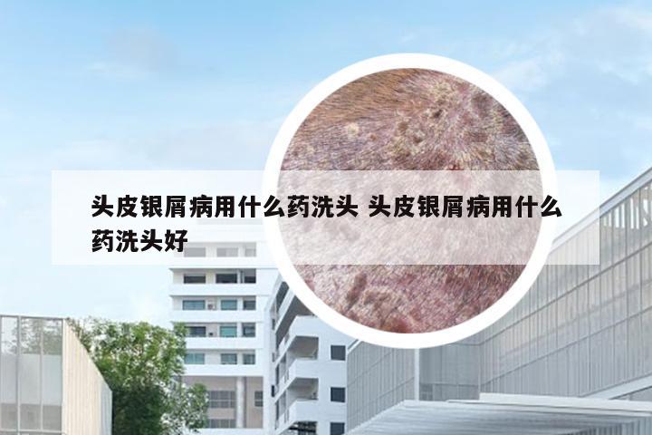 头皮银屑病用什么药洗头 头皮银屑病用什么药洗头好