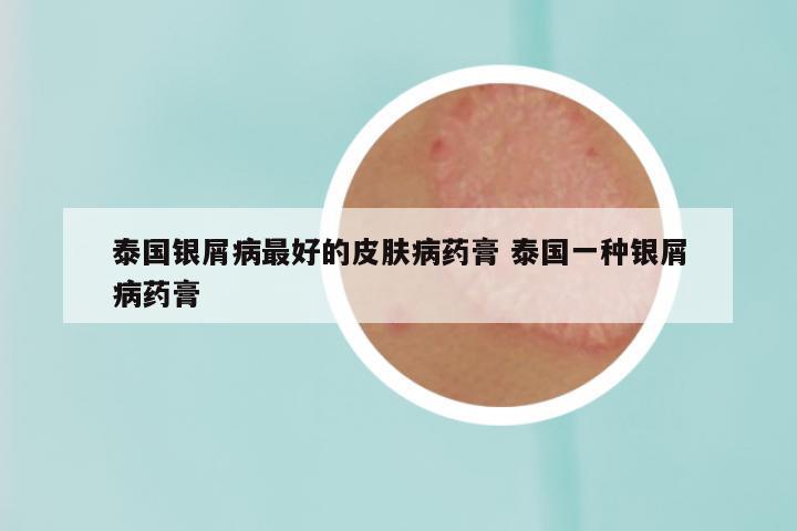 泰国银屑病最好的皮肤病药膏 泰国一种银屑病药膏