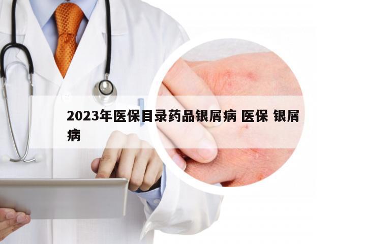 2023年医保目录药品银屑病 医保 银屑病
