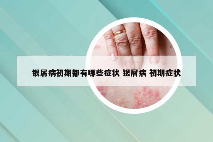银屑病初期都有哪些症状 银屑病 初期症状