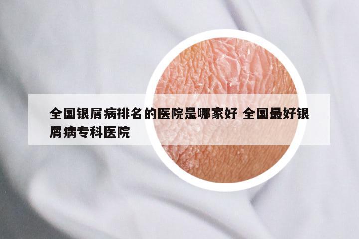 全国银屑病排名的医院是哪家好 全国最好银屑病专科医院