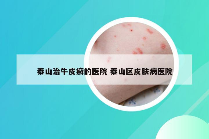泰山治牛皮癣的医院 泰山区皮肤病医院