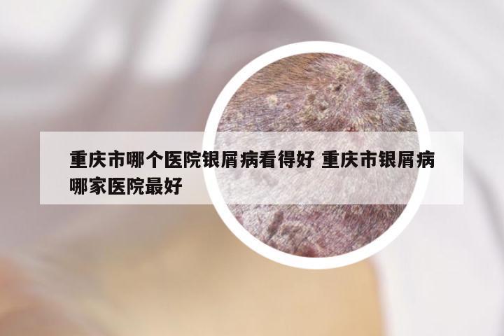 重庆市哪个医院银屑病看得好 重庆市银屑病哪家医院最好