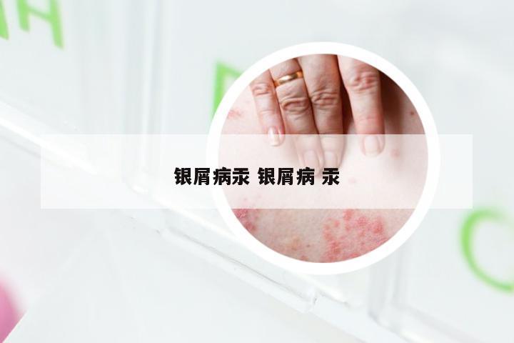 银屑病汞 银屑病 汞