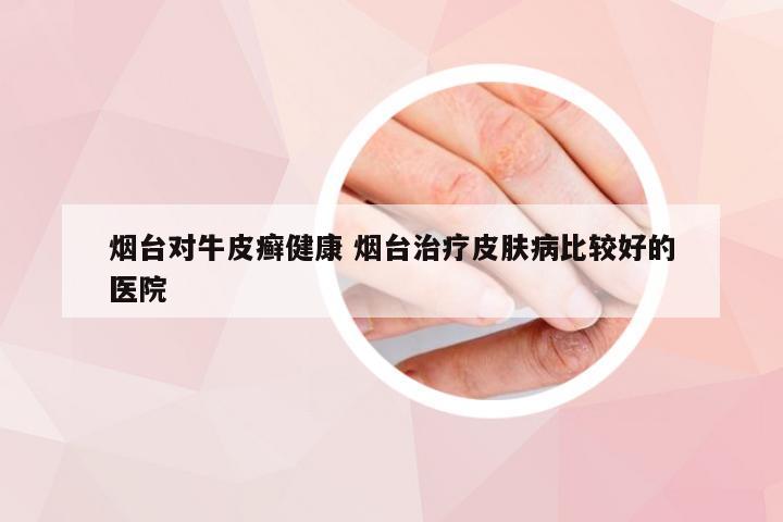 烟台对牛皮癣健康 烟台治疗皮肤病比较好的医院