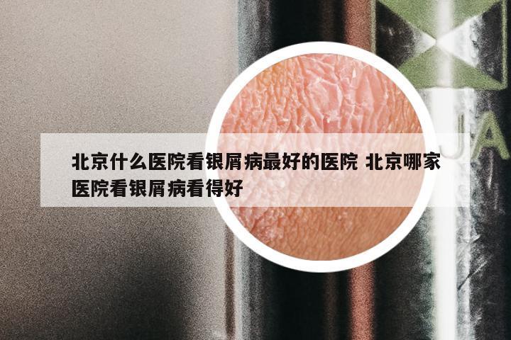 北京什么医院看银屑病最好的医院 北京哪家医院看银屑病看得好
