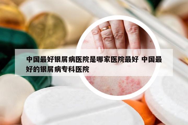 中国最好银屑病医院是哪家医院最好 中国最好的银屑病专科医院