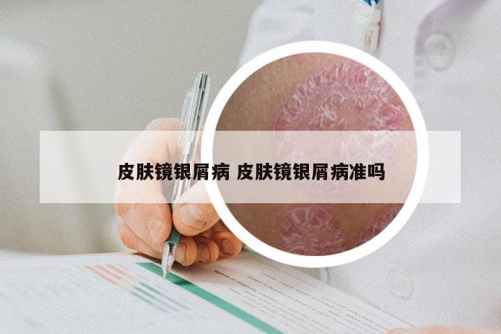 皮肤镜银屑病 皮肤镜银屑病准吗