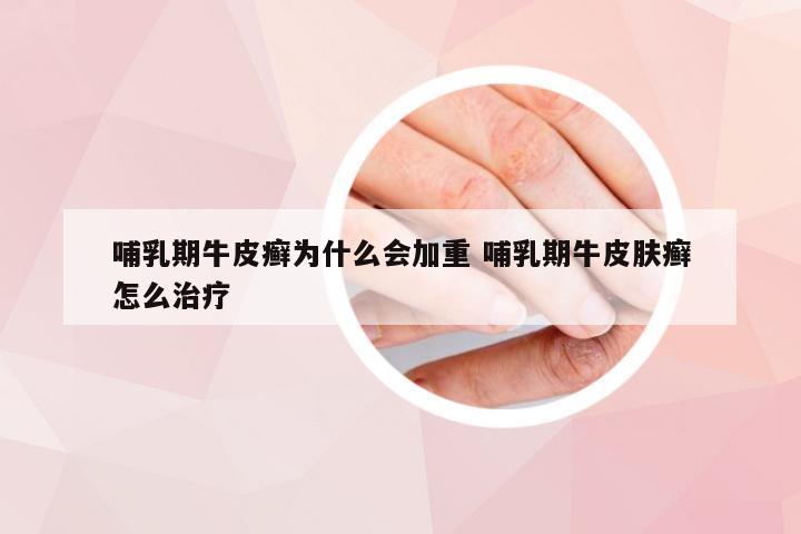 哺乳期牛皮癣为什么会加重 哺乳期牛皮肤癣怎么治疗