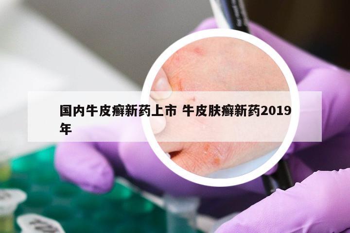 国内牛皮癣新药上市 牛皮肤癣新药2019年