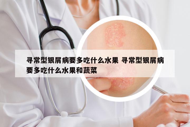 寻常型银屑病要多吃什么水果 寻常型银屑病要多吃什么水果和蔬菜