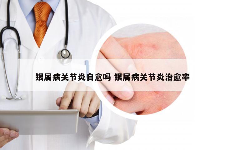 银屑病关节炎自愈吗 银屑病关节炎治愈率