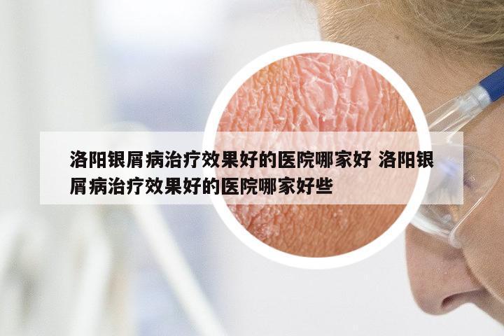 洛阳银屑病治疗效果好的医院哪家好 洛阳银屑病治疗效果好的医院哪家好些