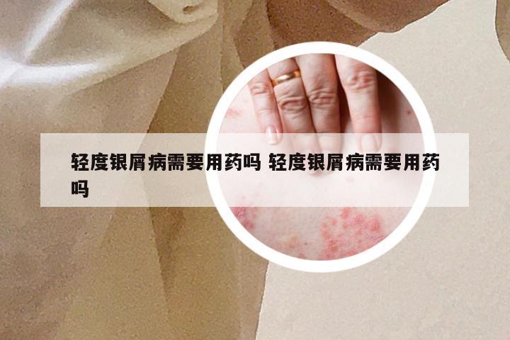 轻度银屑病需要用药吗 轻度银屑病需要用药吗