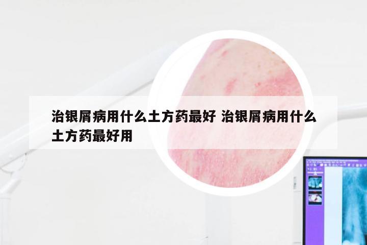 治银屑病用什么土方药最好 治银屑病用什么土方药最好用