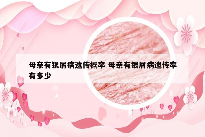 母亲有银屑病遗传概率 母亲有银屑病遗传率有多少