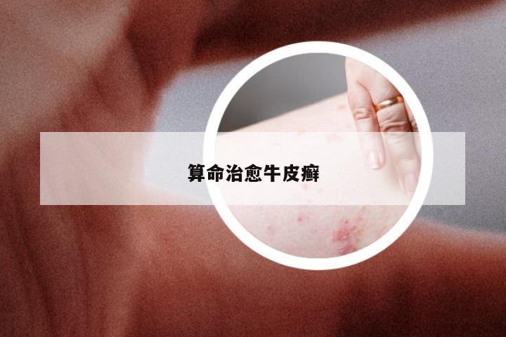 算命治愈牛皮癣