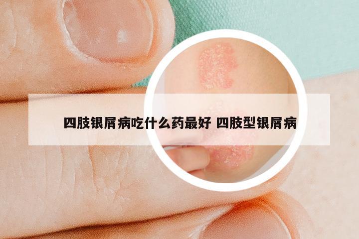 四肢银屑病吃什么药最好 四肢型银屑病