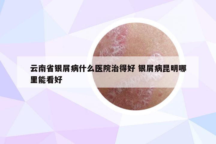 云南省银屑病什么医院治得好 银屑病昆明哪里能看好