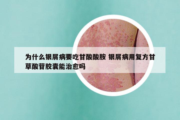 为什么银屑病要吃甘酸酸胺 银屑病用复方甘草酸苷胶囊能治愈吗