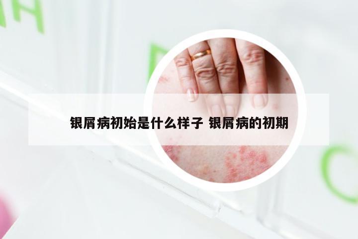 银屑病初始是什么样子 银屑病的初期