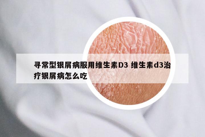 寻常型银屑病服用维生素D3 维生素d3治疗银屑病怎么吃