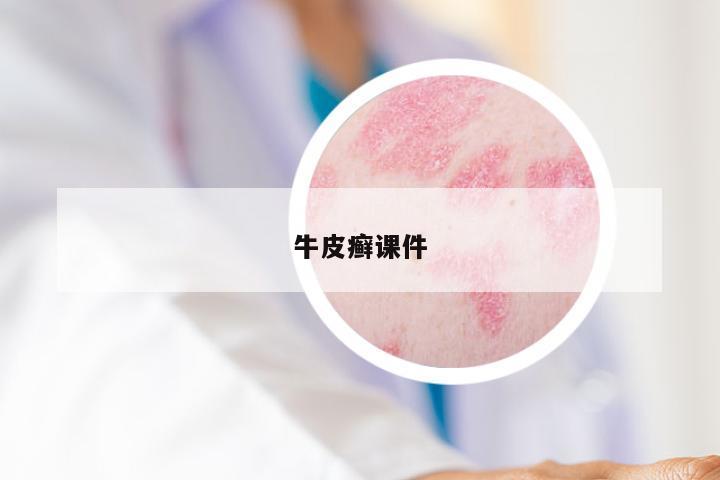 牛皮癣课件