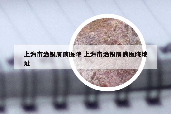 上海市治银屑病医院 上海市治银屑病医院地址