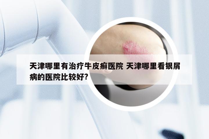 天津哪里有治疗牛皮癣医院 天津哪里看银屑病的医院比较好?