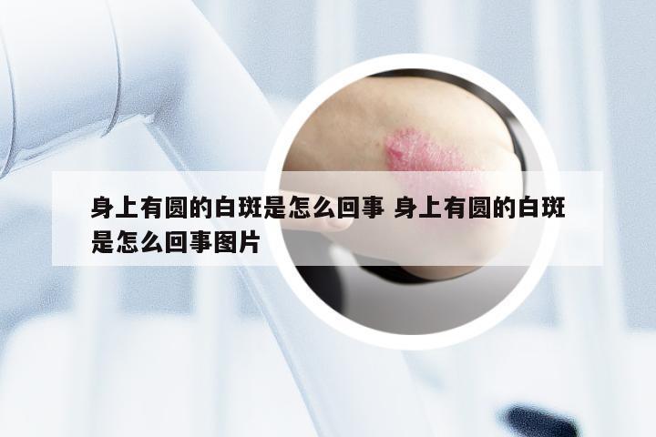 身上有圆的白斑是怎么回事 身上有圆的白斑是怎么回事图片