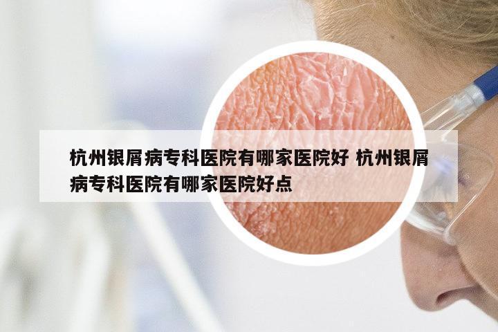 杭州银屑病专科医院有哪家医院好 杭州银屑病专科医院有哪家医院好点