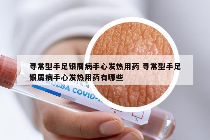 寻常型手足银屑病手心发热用药 寻常型手足银屑病手心发热用药有哪些
