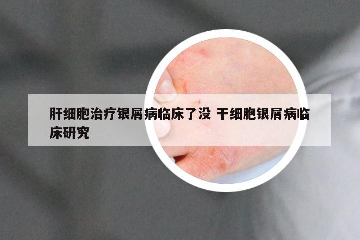 肝细胞治疗银屑病临床了没 干细胞银屑病临床研究