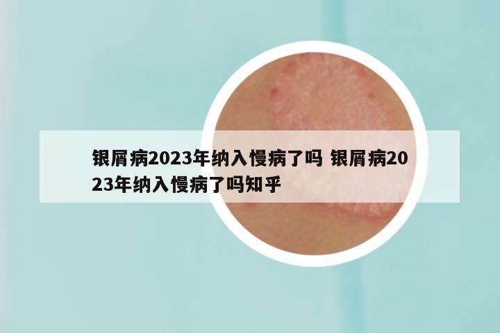 银屑病2023年纳入慢病了吗 银屑病2023年纳入慢病了吗知乎
