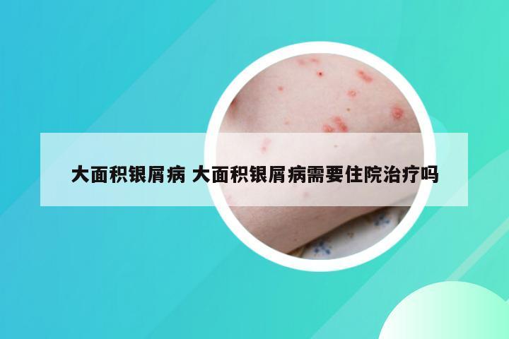 大面积银屑病 大面积银屑病需要住院治疗吗
