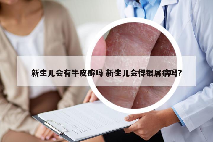 新生儿会有牛皮癣吗 新生儿会得银屑病吗?