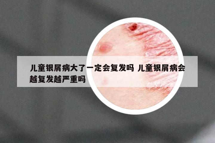 儿童银屑病大了一定会复发吗 儿童银屑病会越复发越严重吗