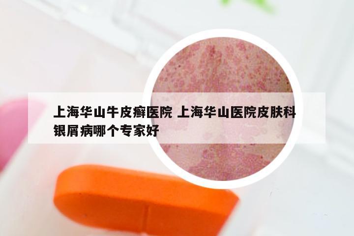 上海华山牛皮癣医院 上海华山医院皮肤科 银屑病哪个专家好